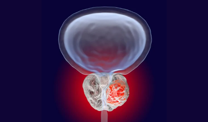 Simulação 3D de um tumor na glândula prostática