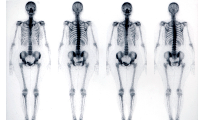 Exemplo de uma imagem obtida a partir da cintilografia óssea