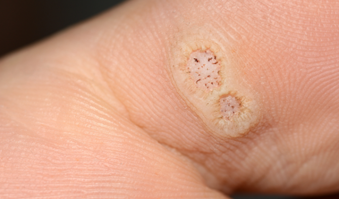 Pele com lesão provocada pelo HPV