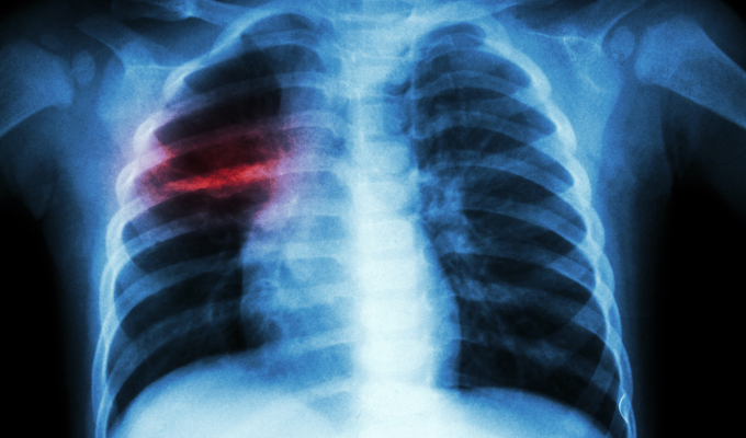Chapa do raio X de um pulmão com sinais de tuberculose