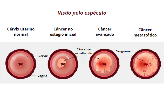 Março lilás: ilustração do colo do útero normal e nos demais estágios do câncer visto pelo espéculo